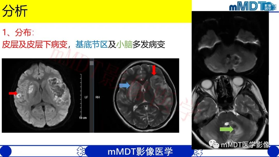 影像PPT - 【PPT】系统性红斑狼疮脑病-17 影像PPT - 【PPT】系统性红斑狼疮脑病-17