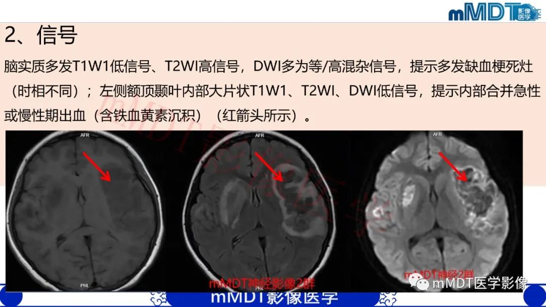 影像PPT - 【PPT】系统性红斑狼疮脑病-18 影像PPT - 【PPT】系统性红斑狼疮脑病-18