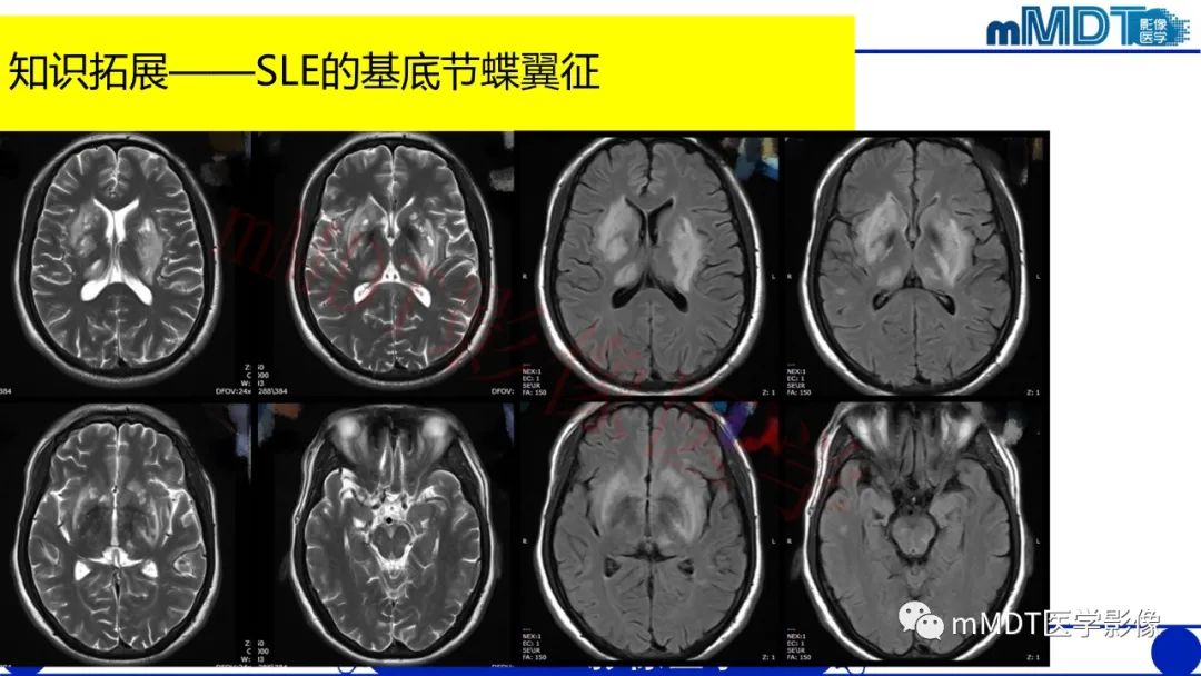 影像PPT - 【PPT】系统性红斑狼疮脑病-21 影像PPT - 【PPT】系统性红斑狼疮脑病-21