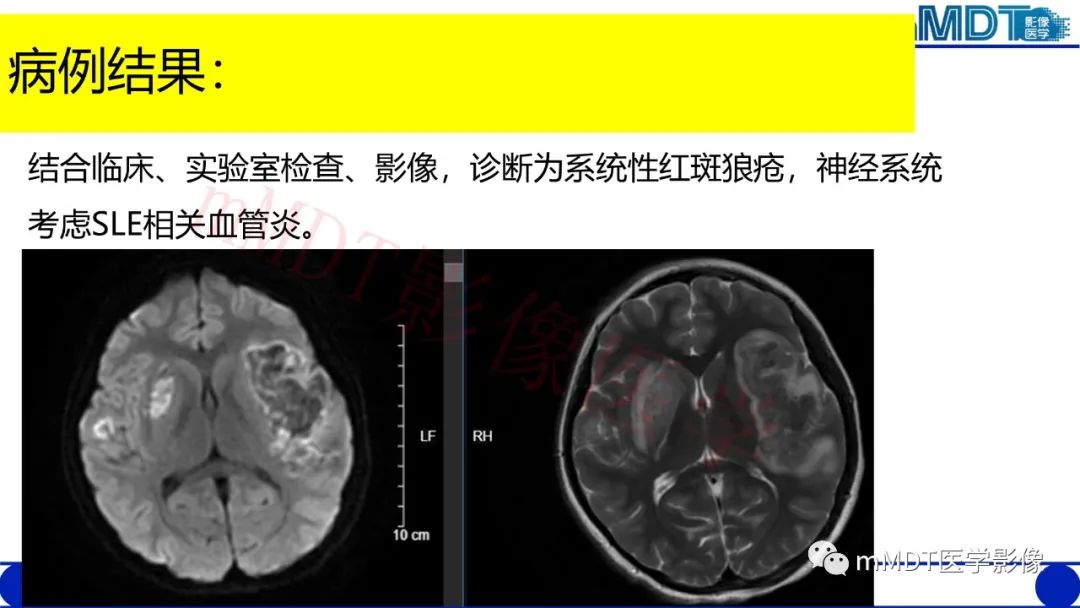 影像PPT - 【PPT】系统性红斑狼疮脑病-23 影像PPT - 【PPT】系统性红斑狼疮脑病-23