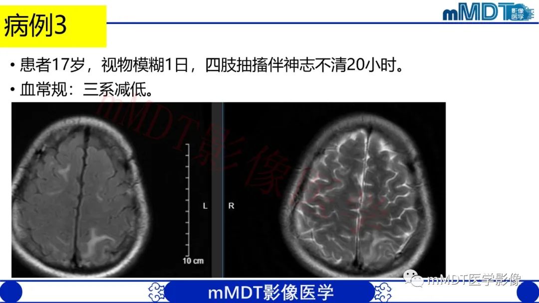 影像PPT - 【PPT】系统性红斑狼疮脑病-24 影像PPT - 【PPT】系统性红斑狼疮脑病-24