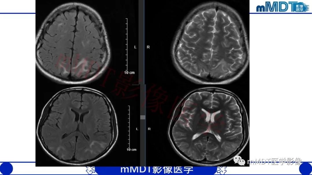 影像PPT - 【PPT】系统性红斑狼疮脑病-25 影像PPT - 【PPT】系统性红斑狼疮脑病-25