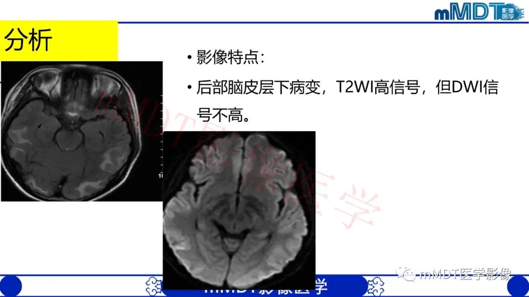 影像PPT - 【PPT】系统性红斑狼疮脑病-27 影像PPT - 【PPT】系统性红斑狼疮脑病-27