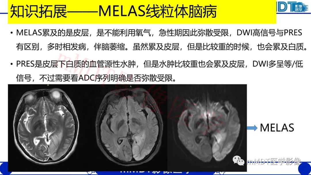 影像PPT - 【PPT】系统性红斑狼疮脑病-29 影像PPT - 【PPT】系统性红斑狼疮脑病-29