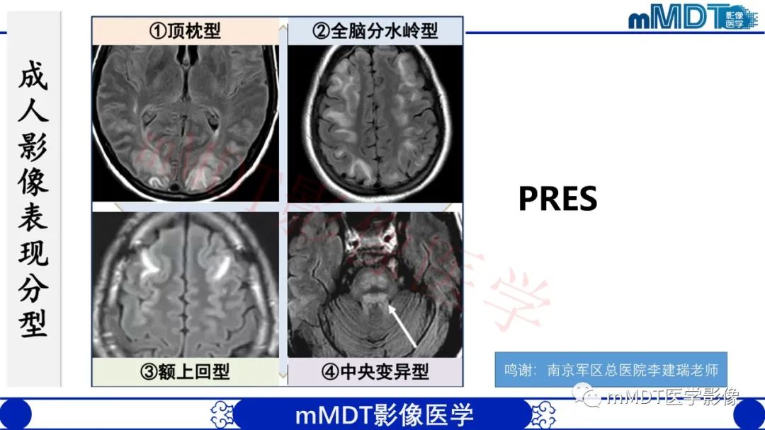 影像PPT - 【PPT】系统性红斑狼疮脑病-32 影像PPT - 【PPT】系统性红斑狼疮脑病-32