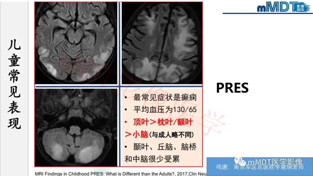 影像PPT - 【PPT】系统性红斑狼疮脑病-33 影像PPT - 【PPT】系统性红斑狼疮脑病-33