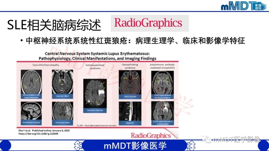 影像PPT - 【PPT】系统性红斑狼疮脑病-36 影像PPT - 【PPT】系统性红斑狼疮脑病-36
