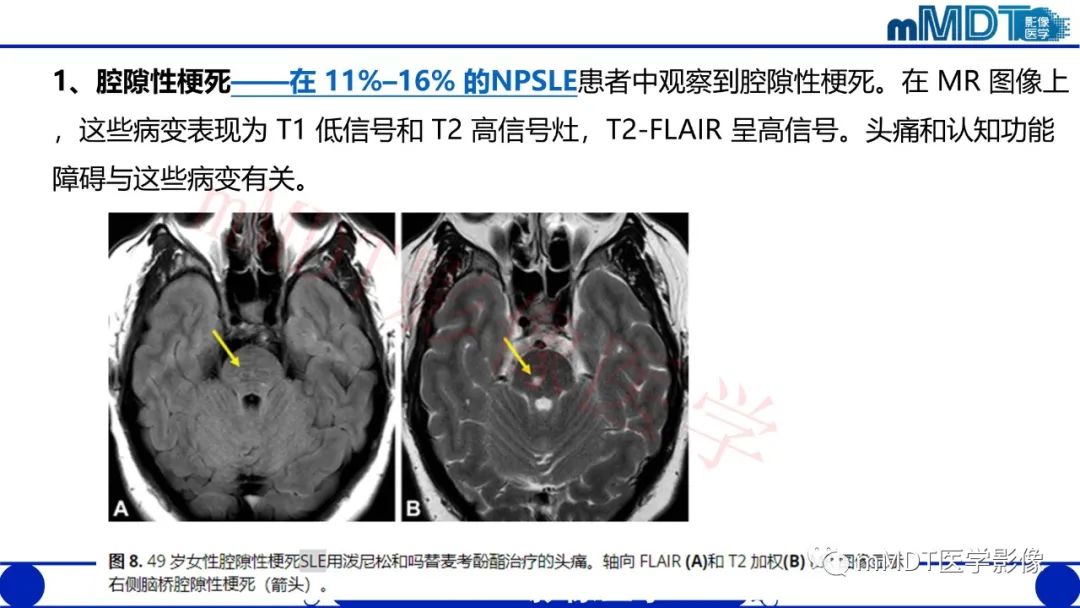 影像PPT - 【PPT】系统性红斑狼疮脑病-39 影像PPT - 【PPT】系统性红斑狼疮脑病-39
