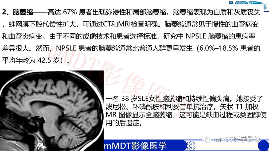 影像PPT - 【PPT】系统性红斑狼疮脑病-40 影像PPT - 【PPT】系统性红斑狼疮脑病-40
