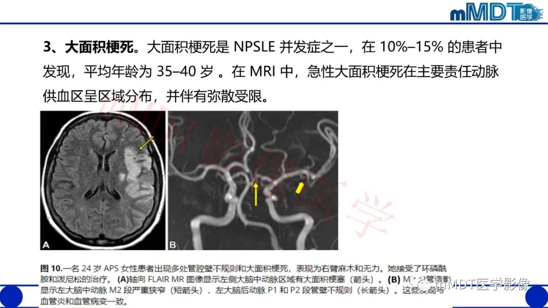 影像PPT - 【PPT】系统性红斑狼疮脑病-41 影像PPT - 【PPT】系统性红斑狼疮脑病-41