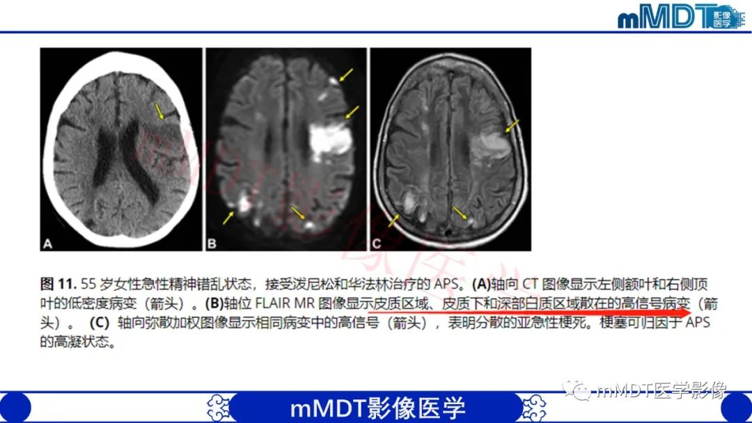 影像PPT - 【PPT】系统性红斑狼疮脑病-44 影像PPT - 【PPT】系统性红斑狼疮脑病-44