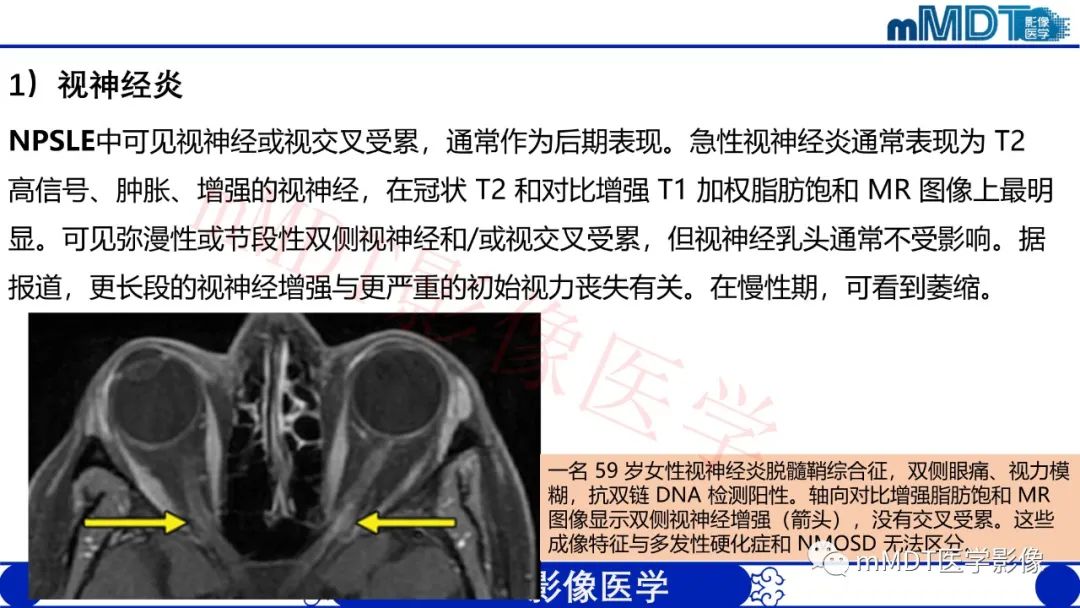 影像PPT - 【PPT】系统性红斑狼疮脑病-46 影像PPT - 【PPT】系统性红斑狼疮脑病-46
