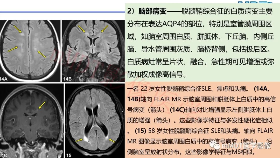 影像PPT - 【PPT】系统性红斑狼疮脑病-47 影像PPT - 【PPT】系统性红斑狼疮脑病-47