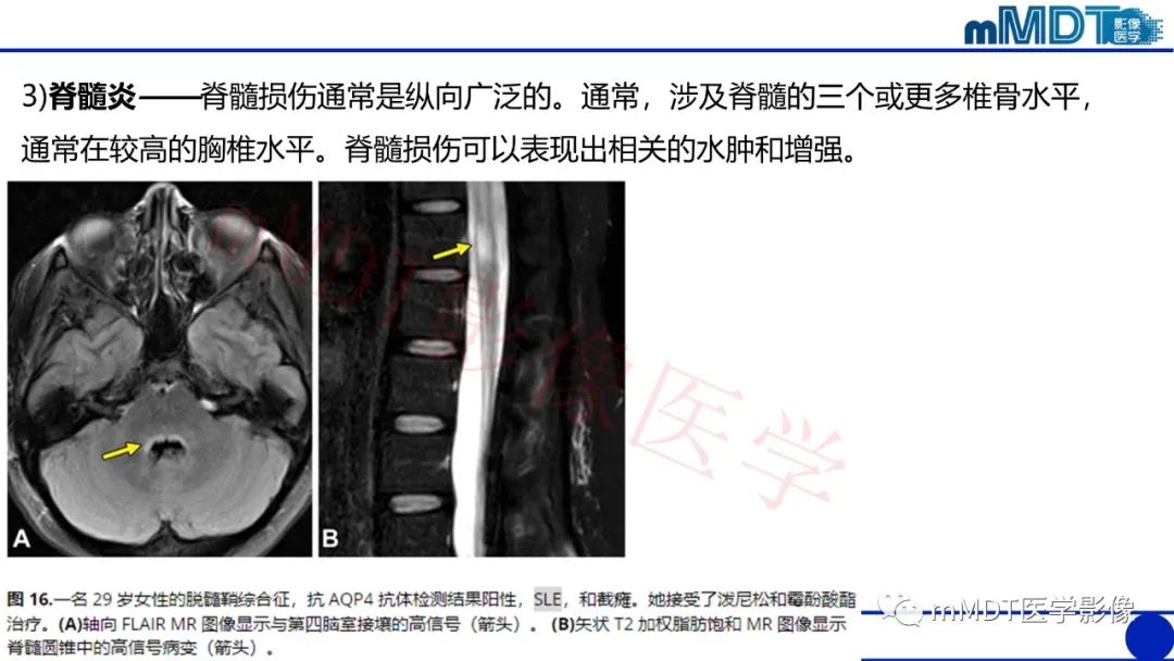 影像PPT - 【PPT】系统性红斑狼疮脑病-48 影像PPT - 【PPT】系统性红斑狼疮脑病-48