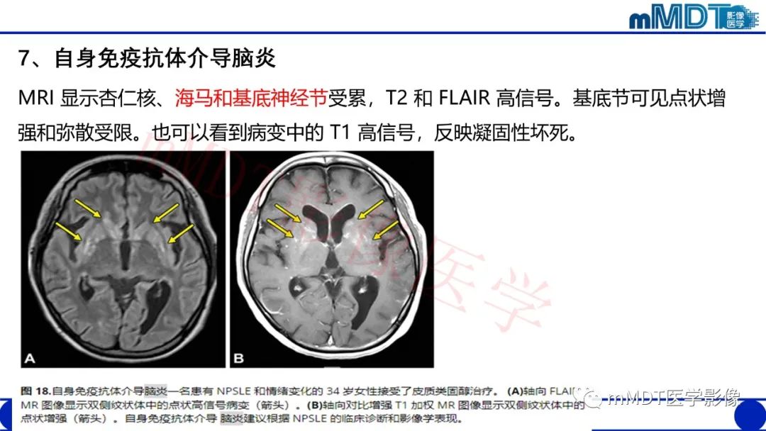 影像PPT - 【PPT】系统性红斑狼疮脑病-49 影像PPT - 【PPT】系统性红斑狼疮脑病-49