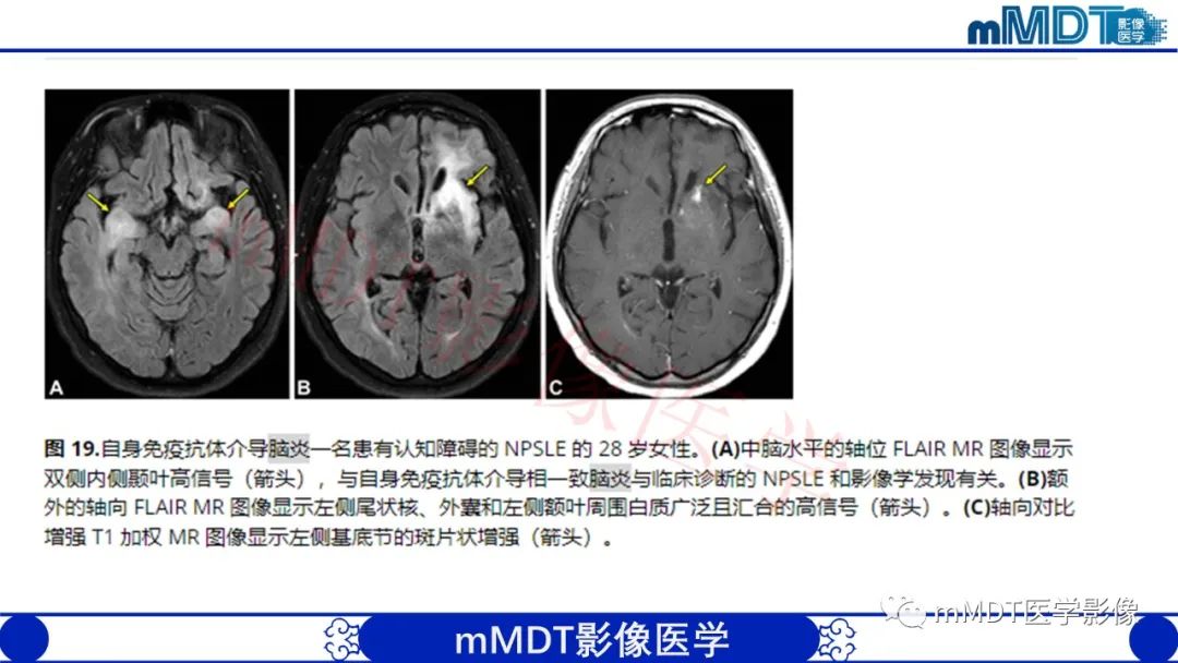 影像PPT - 【PPT】系统性红斑狼疮脑病-50 影像PPT - 【PPT】系统性红斑狼疮脑病-50