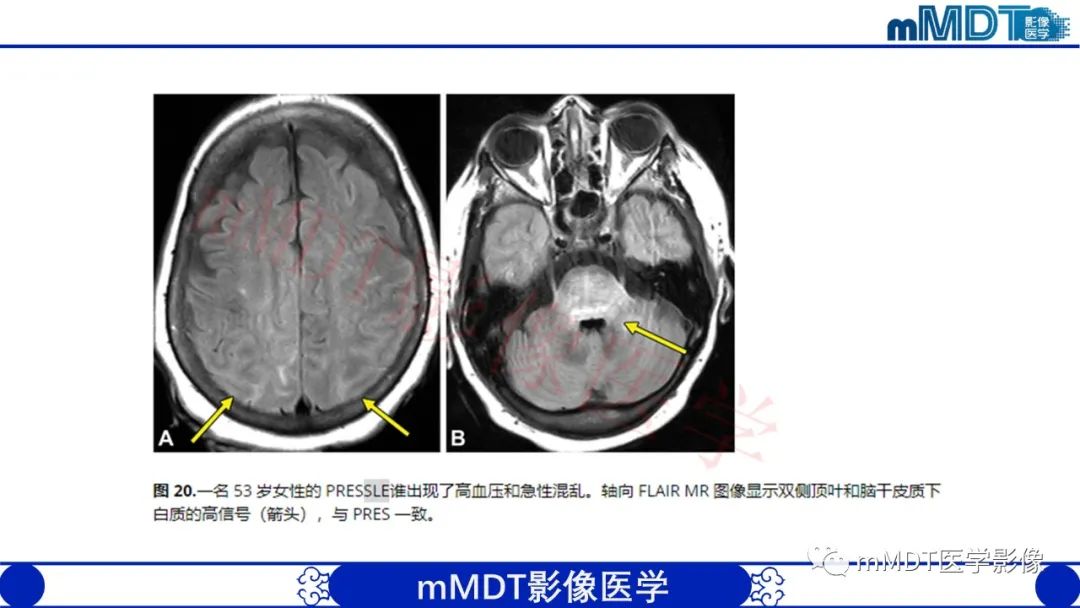 影像PPT - 【PPT】系统性红斑狼疮脑病-52 影像PPT - 【PPT】系统性红斑狼疮脑病-52
