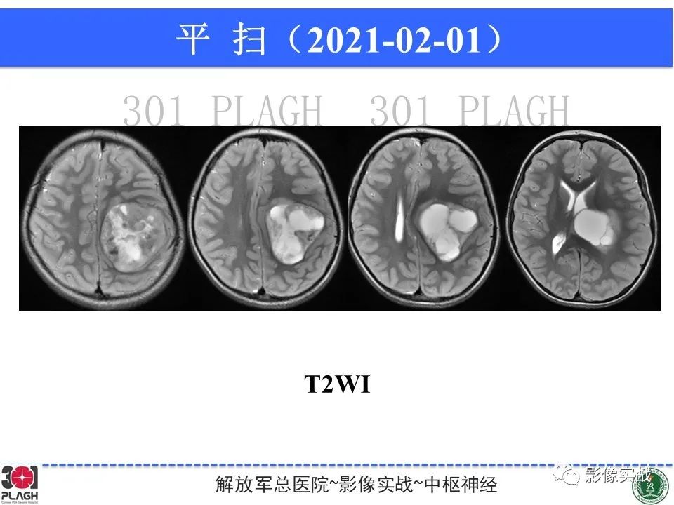 影像PPT - 【病例】幕上室管膜瘤1例MR影像-5
