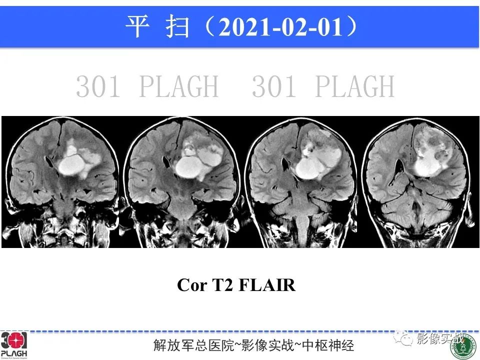 影像PPT - 【病例】幕上室管膜瘤1例MR影像-9