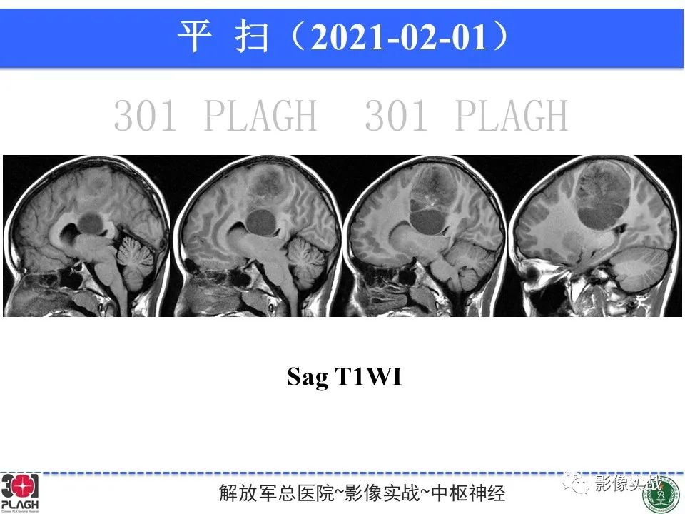 影像PPT - 【病例】幕上室管膜瘤1例MR影像-10