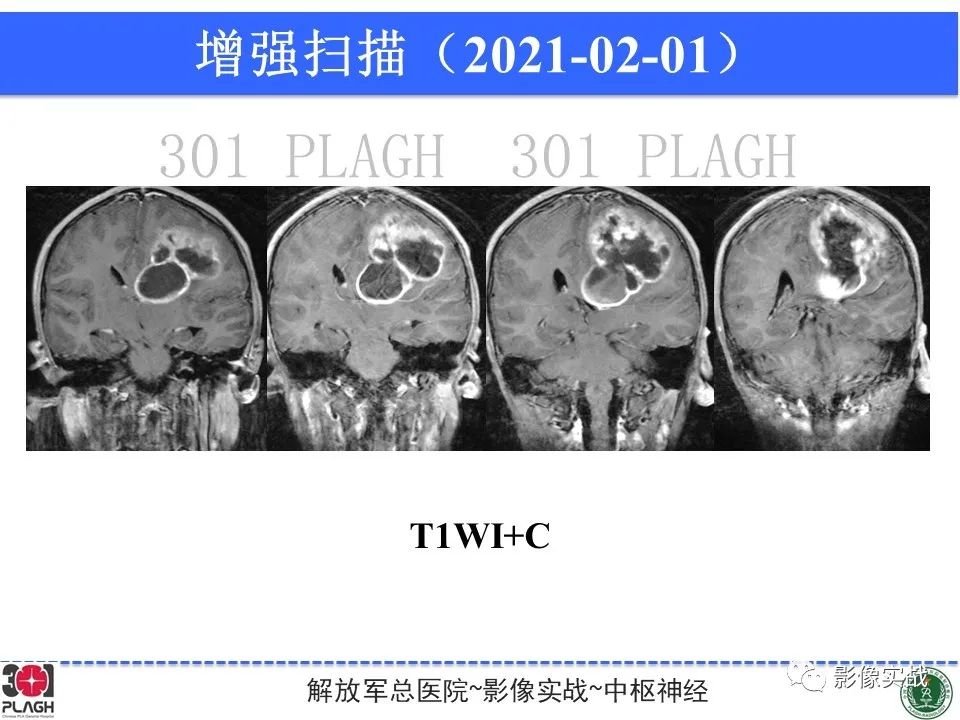影像PPT - 【病例】幕上室管膜瘤1例MR影像-12