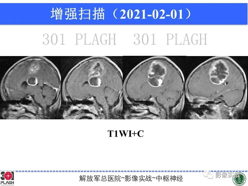 影像PPT - 【病例】幕上室管膜瘤1例MR影像-13