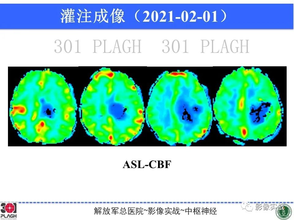 影像PPT - 【病例】幕上室管膜瘤1例MR影像-14