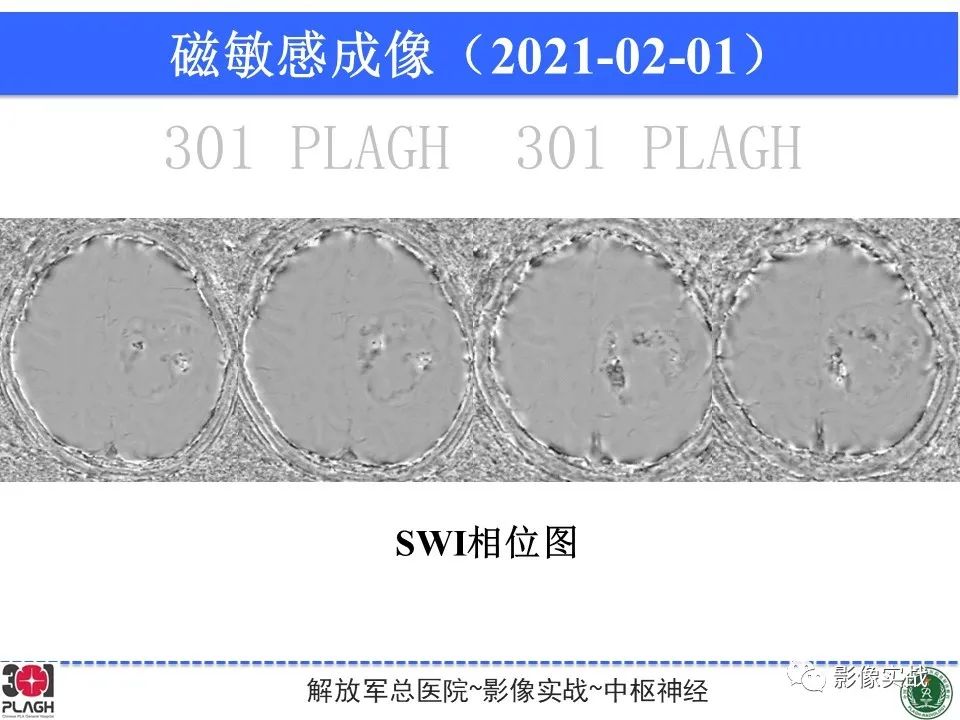 影像PPT - 【病例】幕上室管膜瘤1例MR影像-17