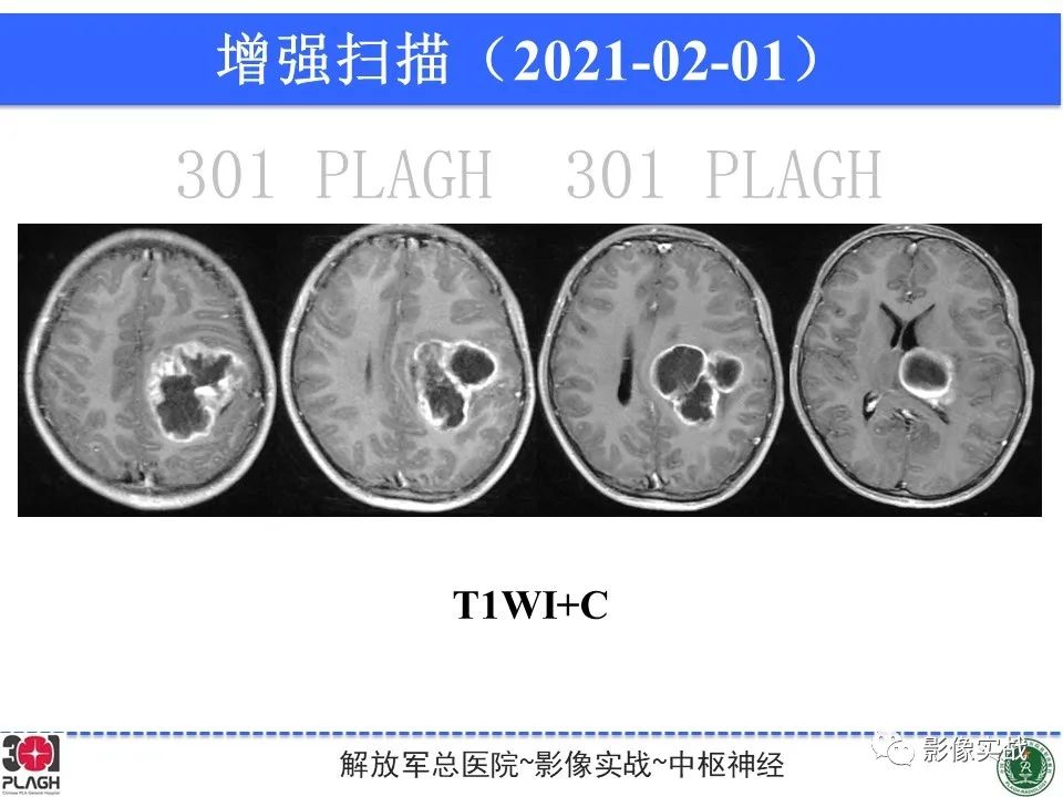 影像PPT - 【病例】幕上室管膜瘤1例MR影像-11