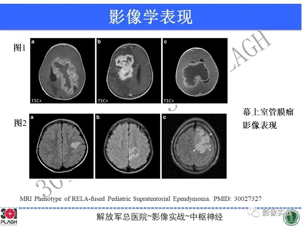 影像PPT - 【病例】幕上室管膜瘤1例MR影像-31