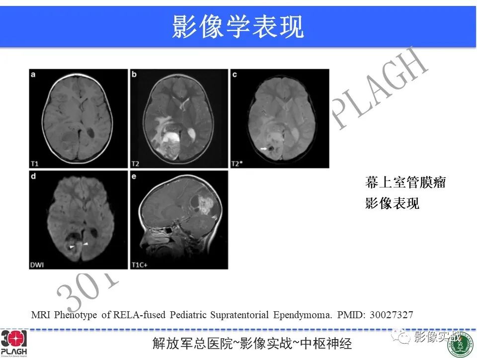 影像PPT - 【病例】幕上室管膜瘤1例MR影像-29
