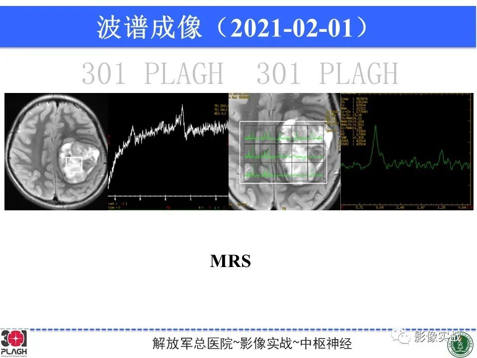 影像PPT - 【病例】幕上室管膜瘤1例MR影像-15