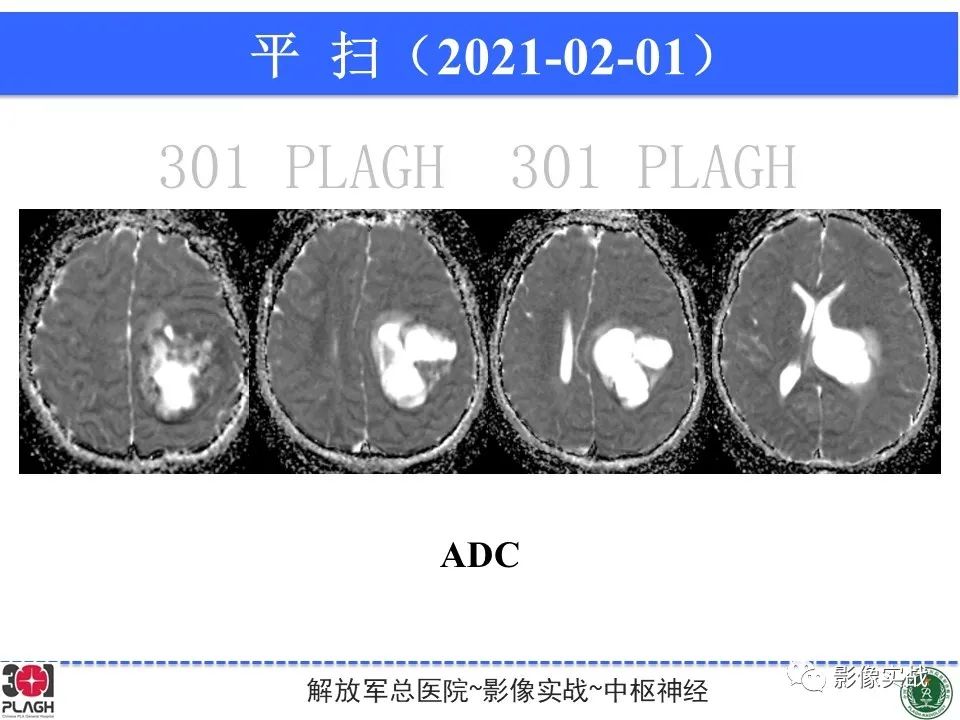影像PPT - 【病例】幕上室管膜瘤1例MR影像-8