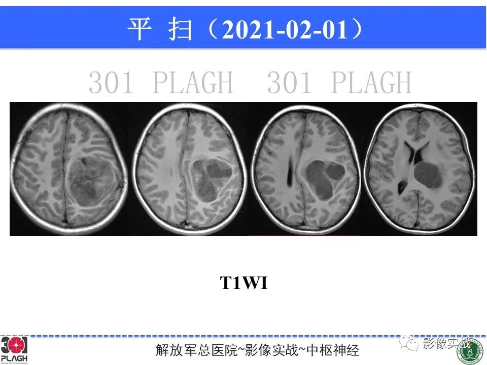 影像PPT - 【病例】幕上室管膜瘤1例MR影像-6