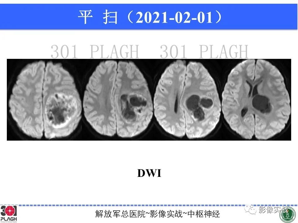 影像PPT - 【病例】幕上室管膜瘤1例MR影像-7