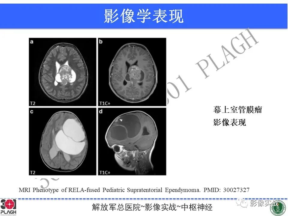 影像PPT - 【病例】幕上室管膜瘤1例MR影像-30