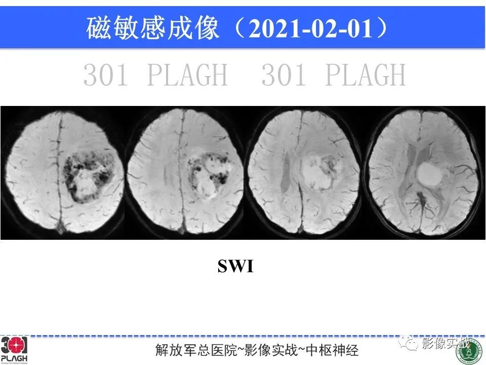 影像PPT - 【病例】幕上室管膜瘤1例MR影像-16