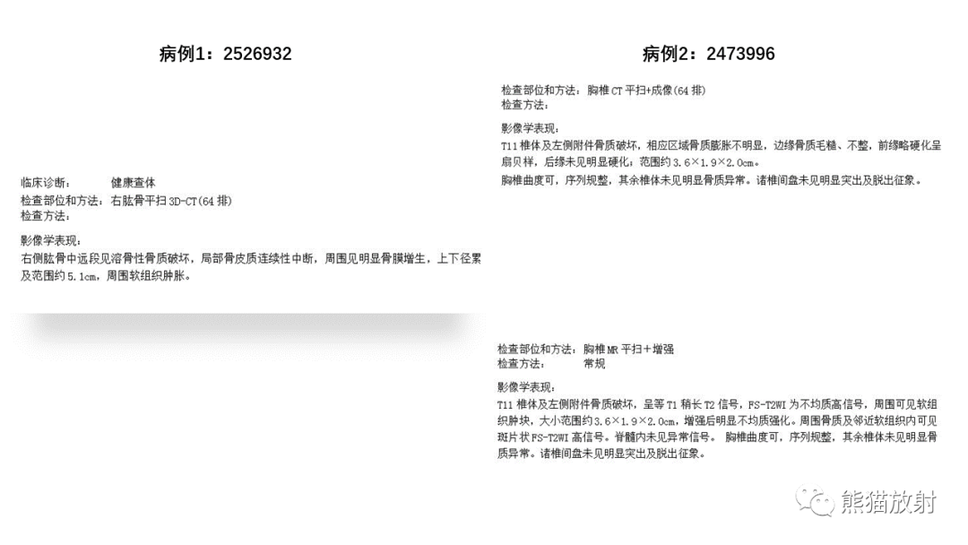 影像PPT - 【病例】长骨及脊柱朗格汉斯组织细胞增生症各1例-18