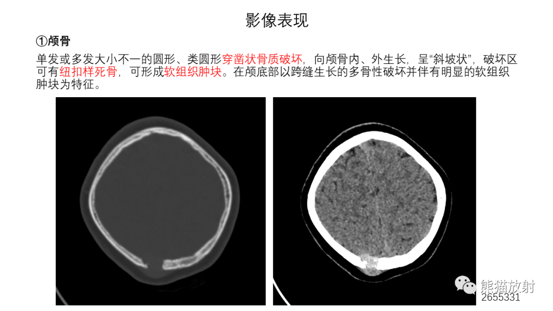 影像PPT - 【病例】长骨及脊柱朗格汉斯组织细胞增生症各1例-22