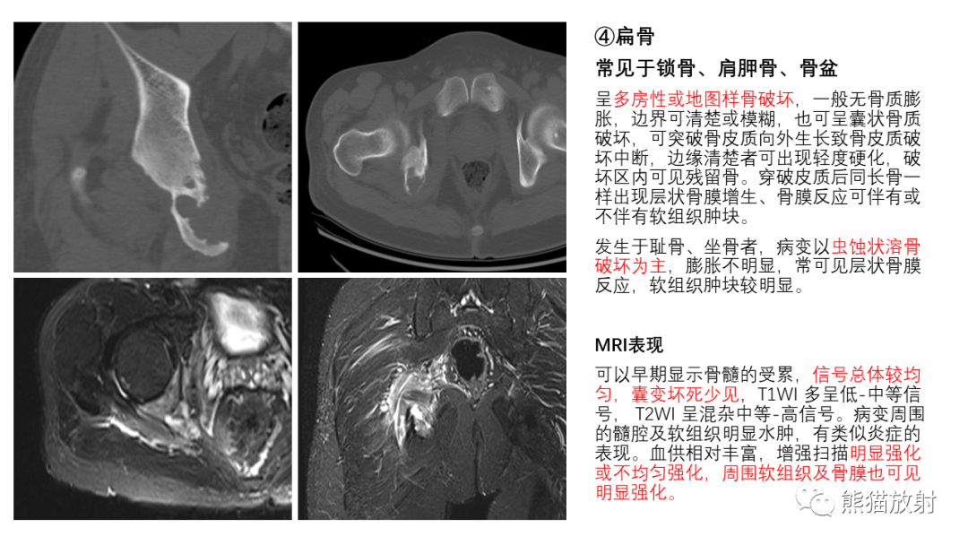 影像PPT - 【病例】长骨及脊柱朗格汉斯组织细胞增生症各1例-25
