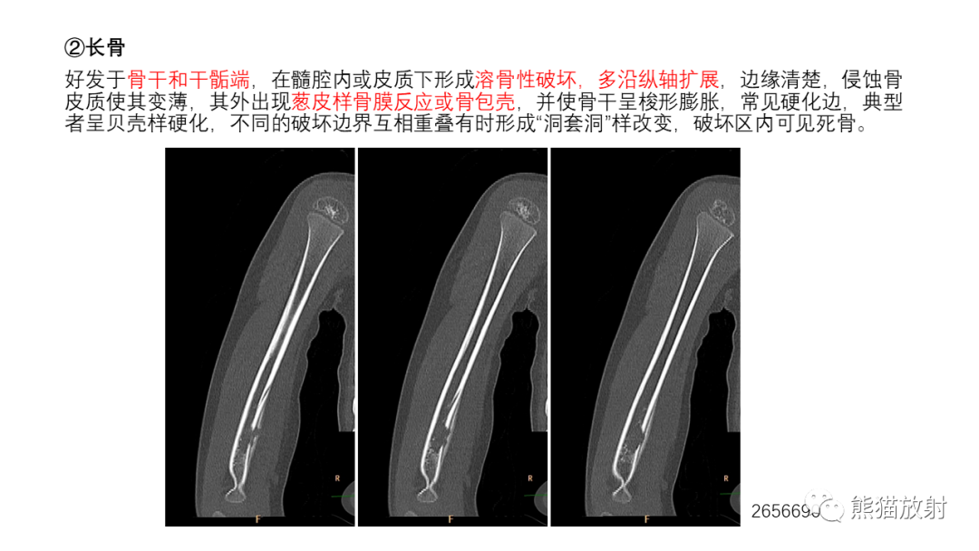 影像PPT - 【病例】长骨及脊柱朗格汉斯组织细胞增生症各1例-23