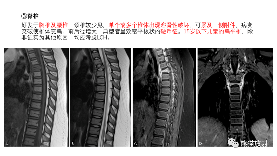 影像PPT - 【病例】长骨及脊柱朗格汉斯组织细胞增生症各1例-24
