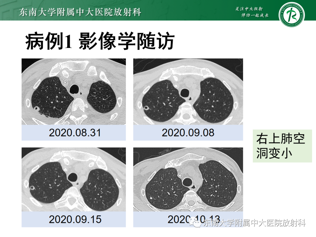 影像PPT - 【PPT】金黄色葡萄球菌肺炎-3 影像PPT - 【PPT】金黄色葡萄球菌肺炎-3