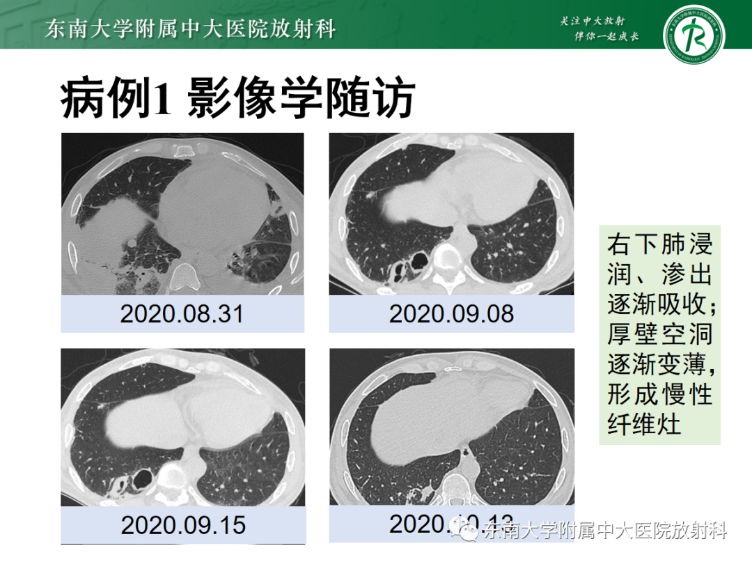 影像PPT - 【PPT】金黄色葡萄球菌肺炎-4 影像PPT - 【PPT】金黄色葡萄球菌肺炎-4