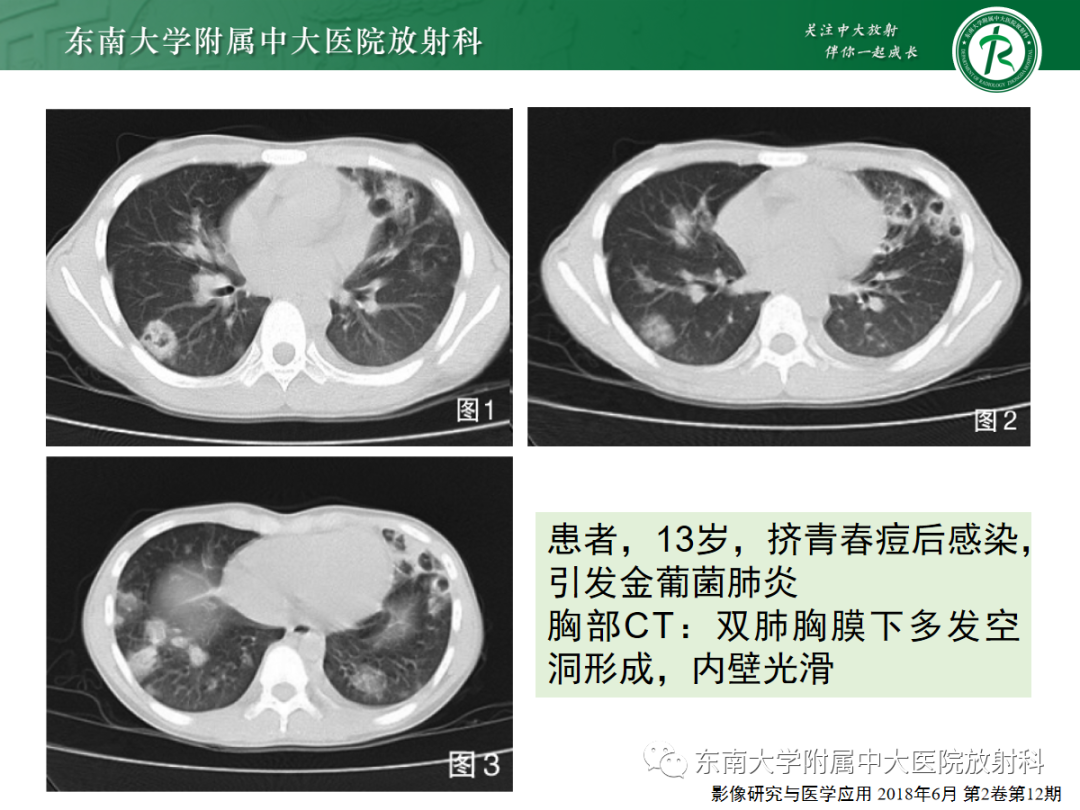 影像PPT - 【PPT】金黄色葡萄球菌肺炎-17 影像PPT - 【PPT】金黄色葡萄球菌肺炎-17