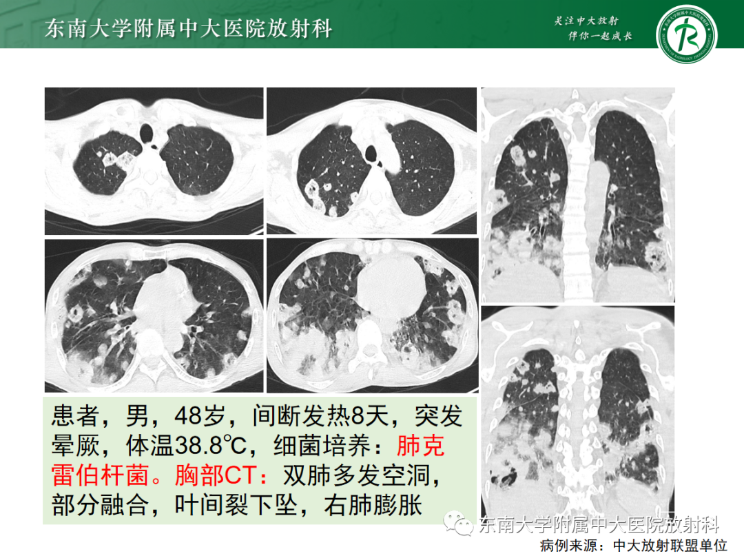 影像PPT - 【PPT】金黄色葡萄球菌肺炎-20 影像PPT - 【PPT】金黄色葡萄球菌肺炎-20