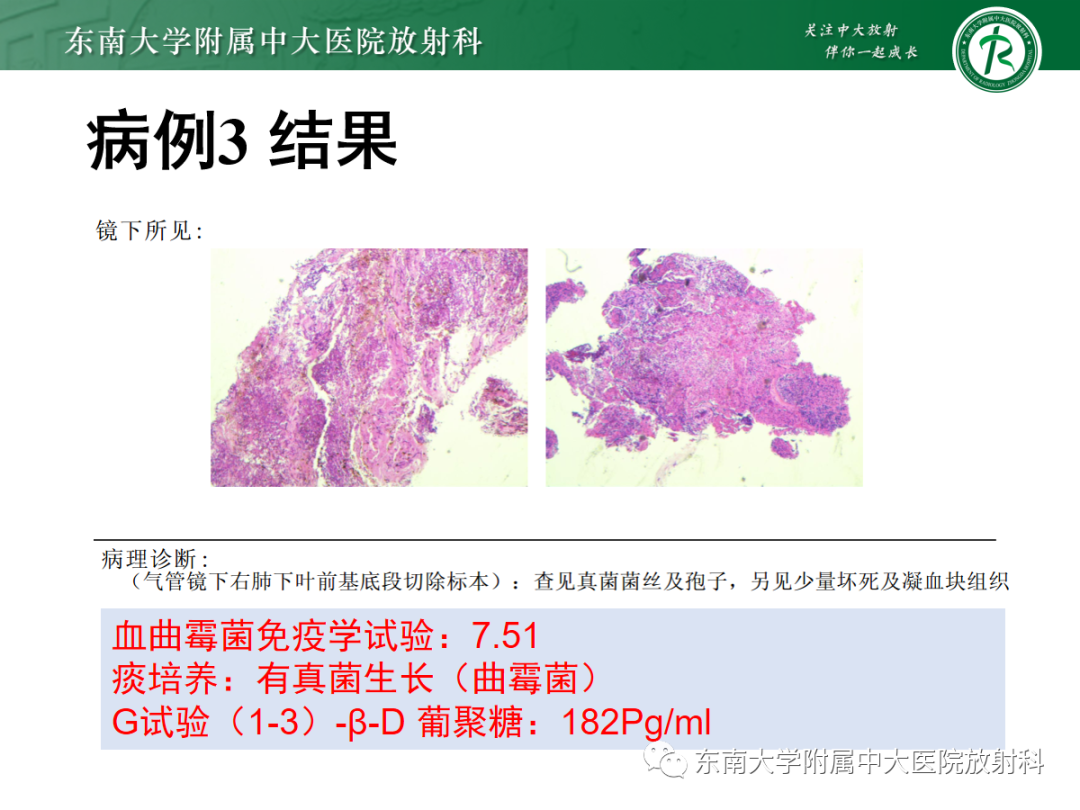 影像PPT - 【PPT】金黄色葡萄球菌肺炎-36 影像PPT - 【PPT】金黄色葡萄球菌肺炎-36