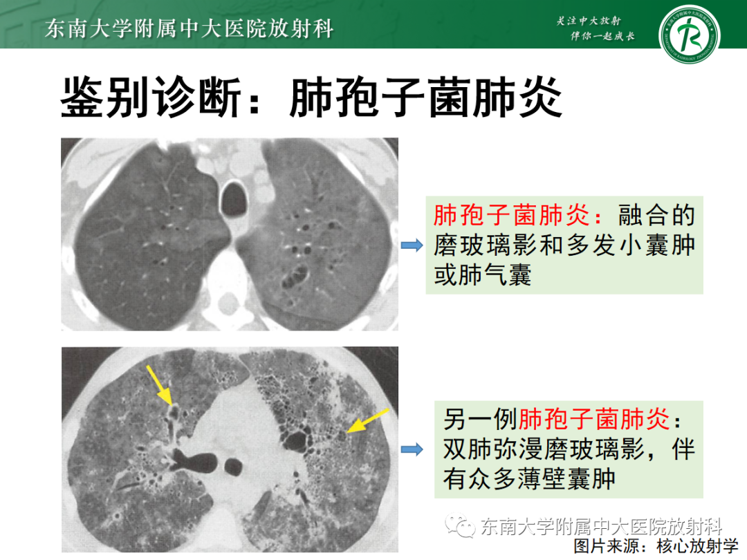影像PPT - 【PPT】金黄色葡萄球菌肺炎-24 影像PPT - 【PPT】金黄色葡萄球菌肺炎-24