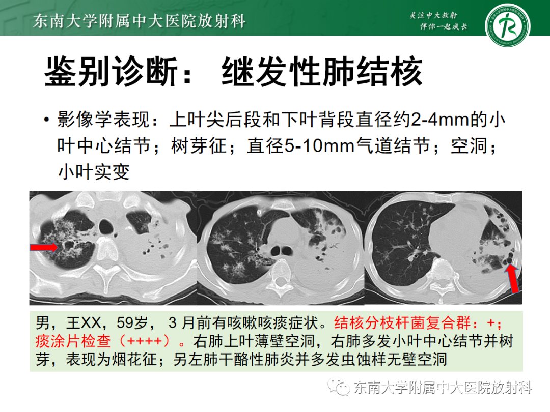 影像PPT - 【PPT】金黄色葡萄球菌肺炎-22 影像PPT - 【PPT】金黄色葡萄球菌肺炎-22