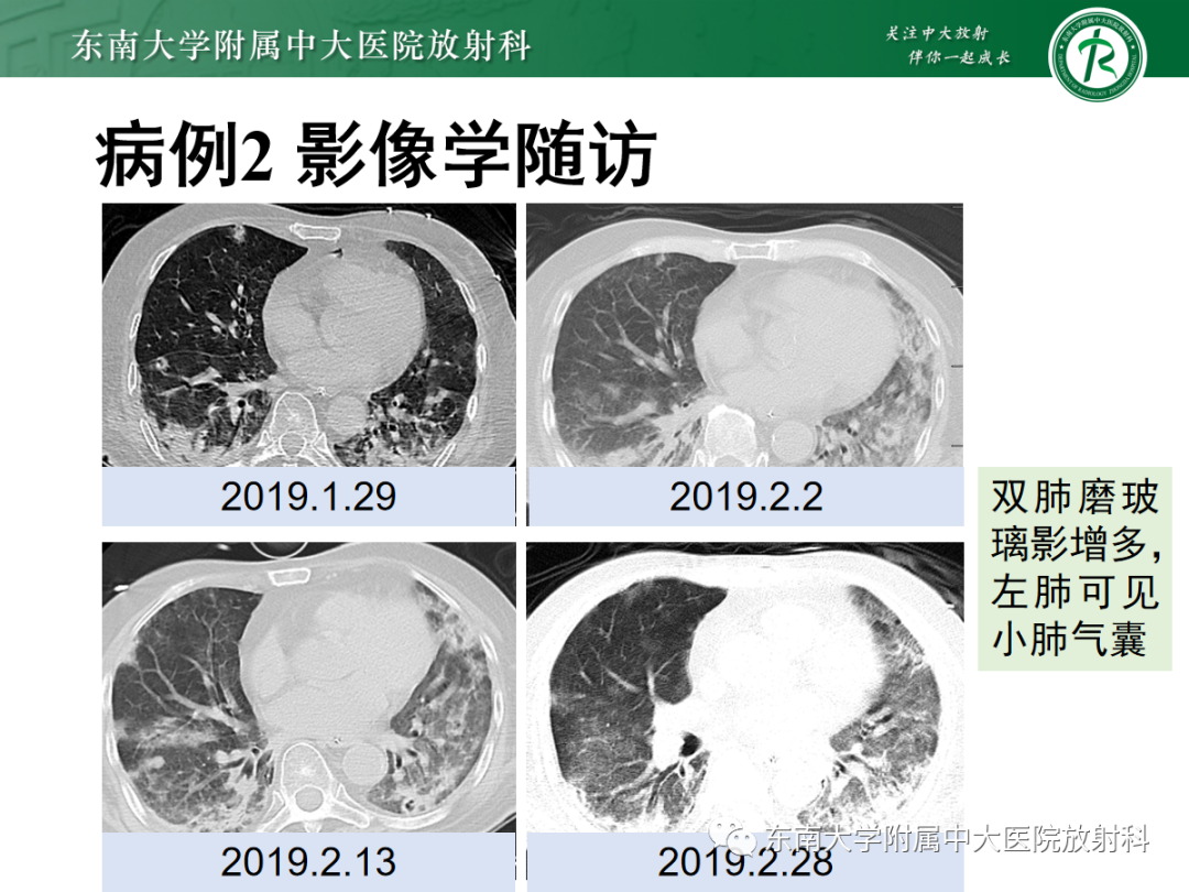 影像PPT - 【PPT】金黄色葡萄球菌肺炎-29 影像PPT - 【PPT】金黄色葡萄球菌肺炎-29